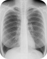 Chest X-Ray