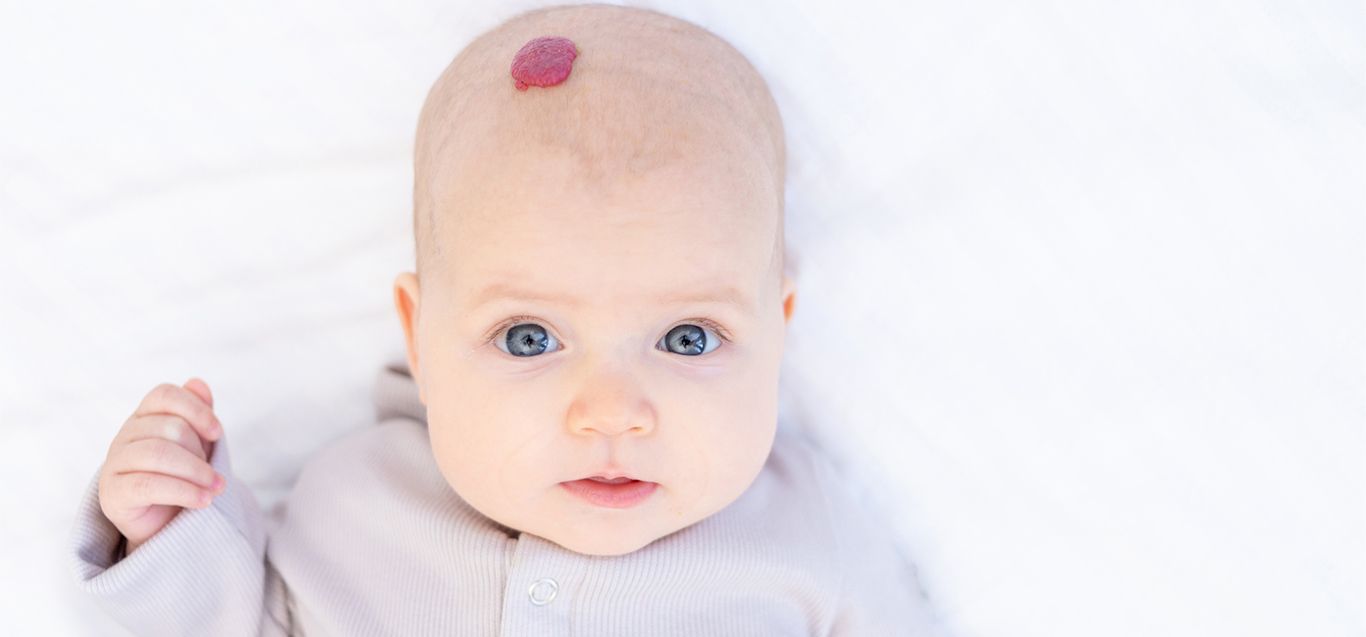 Understanding Vascular Birthmarks