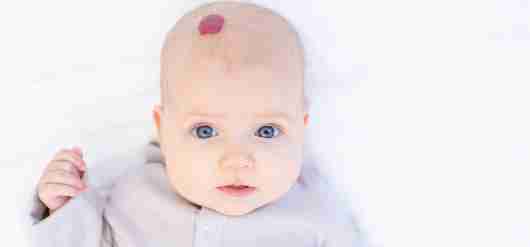 Understanding Vascular Birthmarks