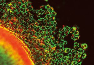 Untangling Neural Crest Cell Migration in Hirschsprung Disease