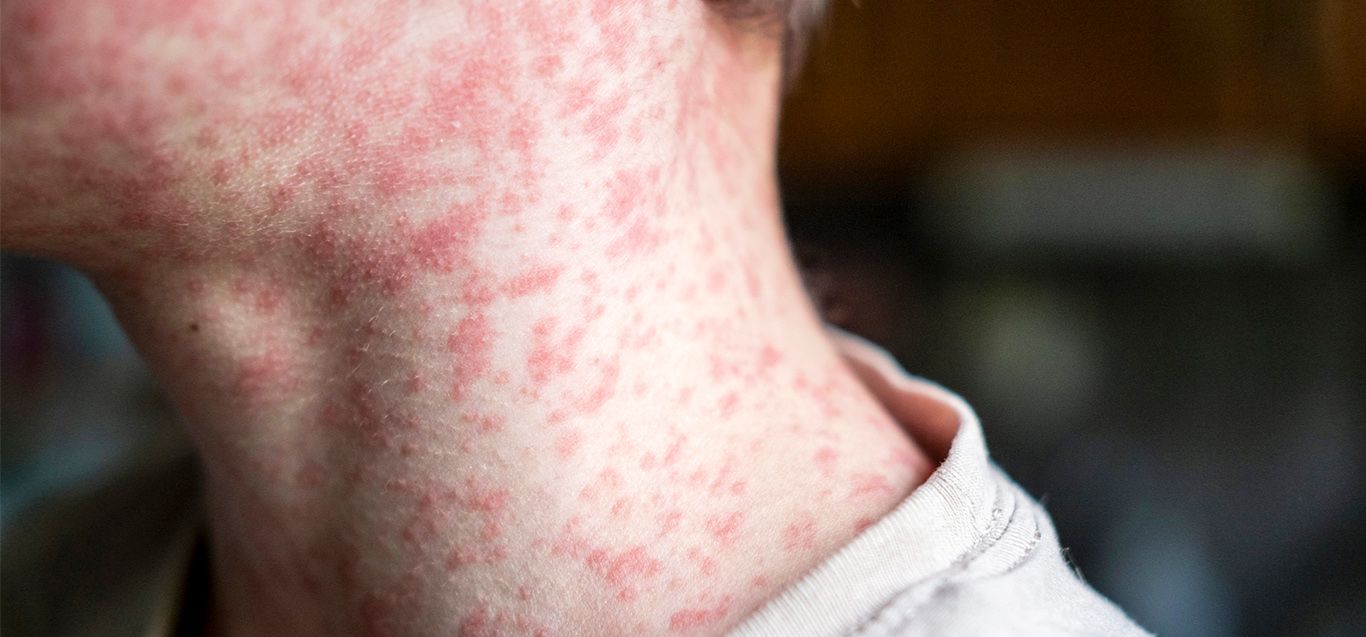 MMR Explained: Protecting Children from Measles, Mumps and Rubella