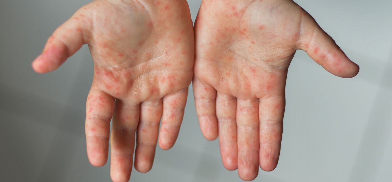 Hand, Foot and Mouth Disease