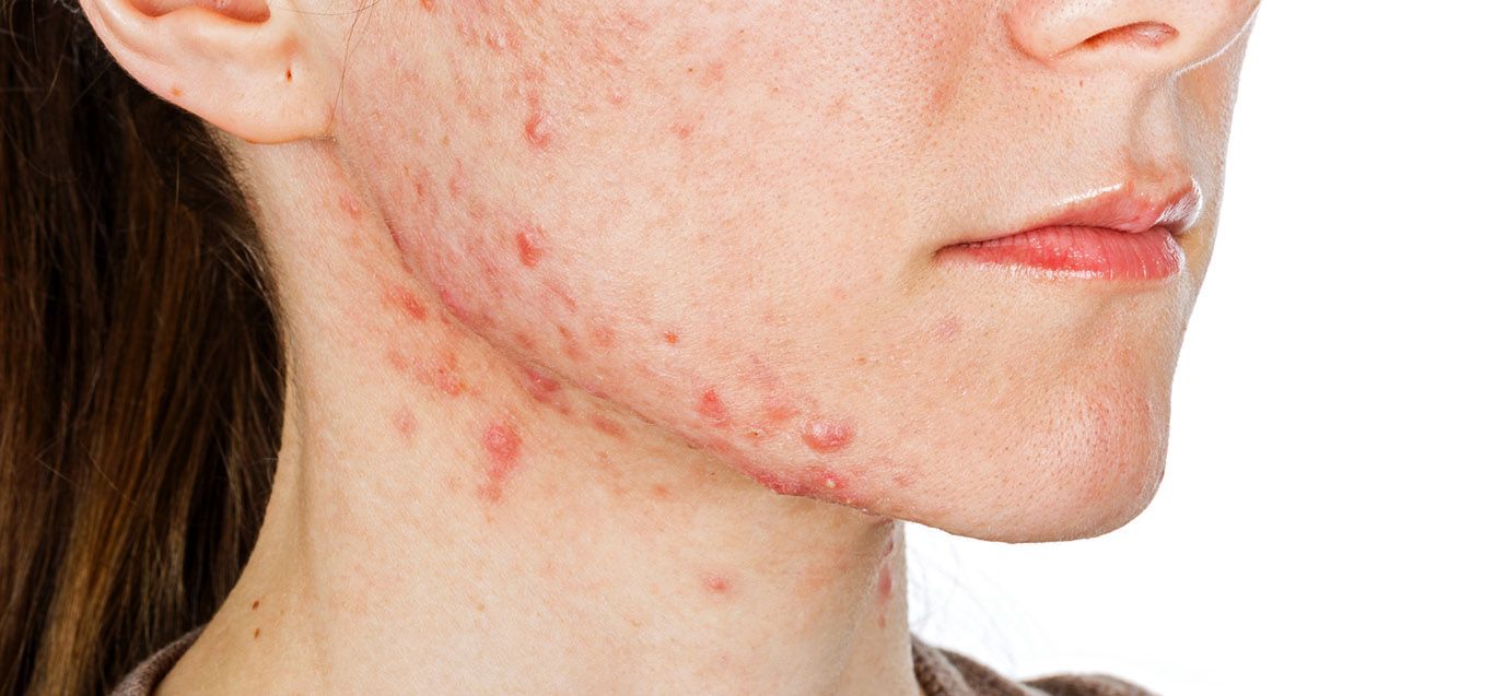 Tips for treating acne from a pediatric dermatologist
