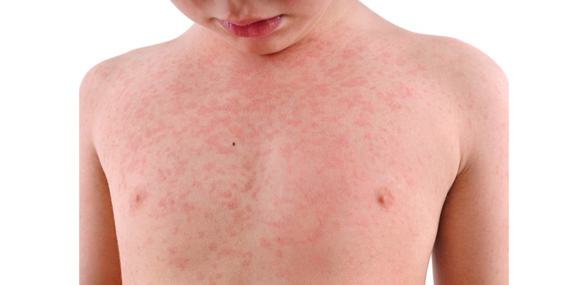 Bumps and Rashes: Common Skin Conditions Explained - Le Bonheur ...