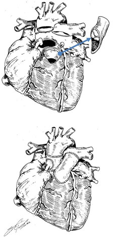 Ross Procedure